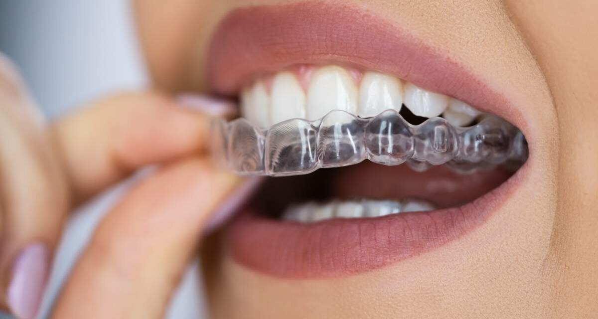 Orthodontie : les techniques d’alignement des dents