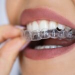 Orthodontie : les techniques d’alignement des dents