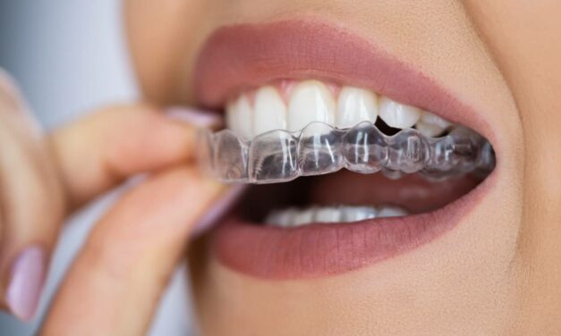 Orthodontie : les techniques d’alignement des dents