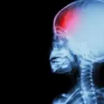 L’AVC périnatal : causes, symptômes et traitements de l’AVC chez les nouveau-nés