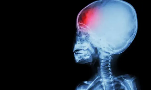 L’AVC périnatal : causes, symptômes et traitements de l’AVC chez les nouveau-nés