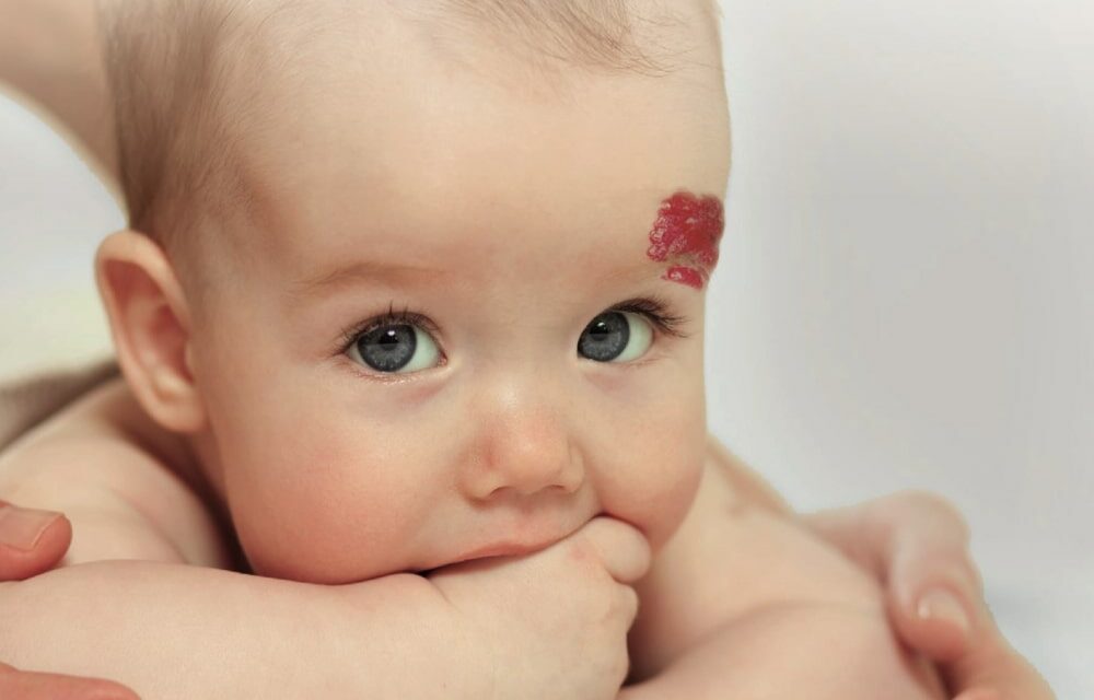 Diagnostic précoce de l’hémangiome infantile : Ne confondez plus avec une simple tache de naissance !