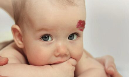 Diagnostic précoce de l’hémangiome infantile : Ne confondez plus avec une simple tache de naissance !