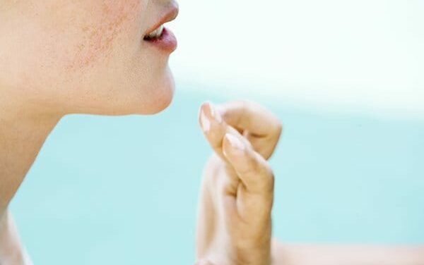 Traiter naturellement l’acné estivale