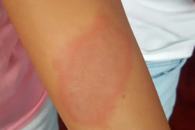 infections-fongiques-résistantes-quand-les-champignons-deviennent-une-menace-pour-notre-sante