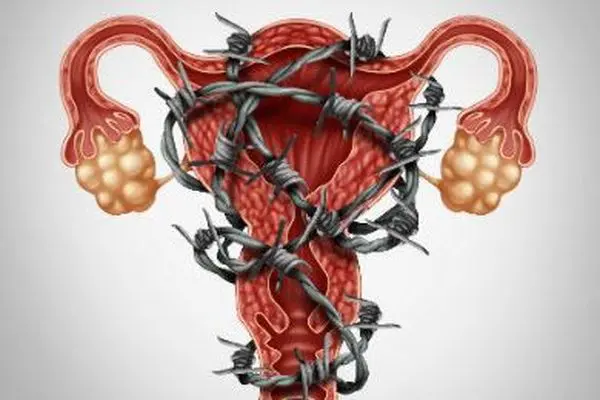 Endométriose et ALD : pourquoi il est temps de reconnaître cette maladie silencieuse