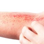 De l’espoir pour les patients atteints d’eczéma atopique