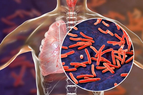 Comment un gène méconnu du chromosome X influence notre lutte contre la tuberculose!