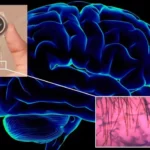 Les implants cérébraux : espoir, mais vigilance