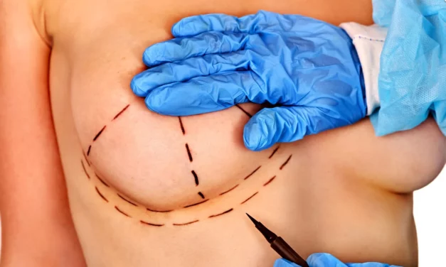 Réduction mammaire : tout ce que vous devez savoir pour un parcours serein