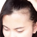 Comprendre la perte de cheveux chez les femmes