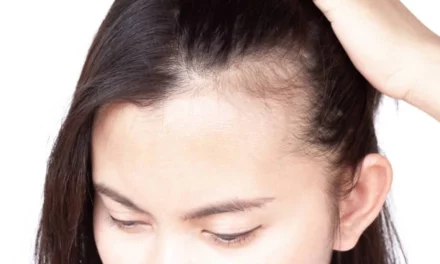 Comprendre la perte de cheveux chez les femmes