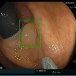 Révolution dans le dépistage du cancer colorectal : l’intelligence artificielle identifie et distingue les polypes avec précision