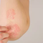 Soigner l’eczéma atopique des enfants par l’homéopathie