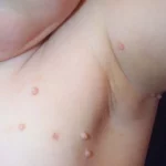 Comment soigner les molluscums contagiosum  grâce à l’homéopathie