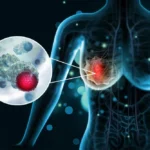 Après un cancer du sein, les inégalités sociales se creusent