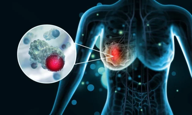 Après un cancer du sein, les inégalités sociales se creusent