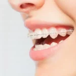 L’évolution de l’orthodontie au Canada : découvrez les nouvelles tendances