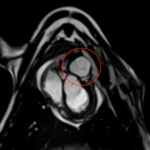 Valve cardiaque en collagène humain : une avancée pour les maladies cardiaques pédiatriques