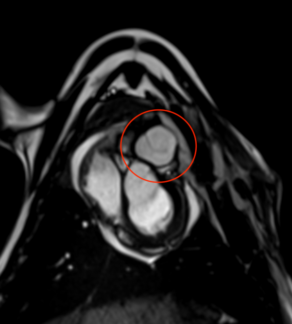 valve-cardiaque-collagene-humain