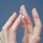 Eczéma des mains : causes, symptômes et traitements efficaces