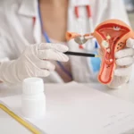Le test salivaire pour diagnostiquer l’endométriose est disponible en France
