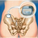 Pacemaker pour la vessie : une révolution contre l’incontinence urinaire