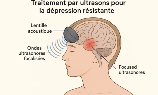 Dépression résistante : une nouvelle thérapie par ultrasons