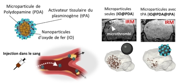 Schéma expliquant le fonctionnement du traitement innovant contre l’AVC mis au point par l’Université de Caen : injection de microparticules d’oxyde de fer recouvertes de polydopamine et de tPA, visualisées en IRM pour dissoudre les micro-caillots cérébraux.