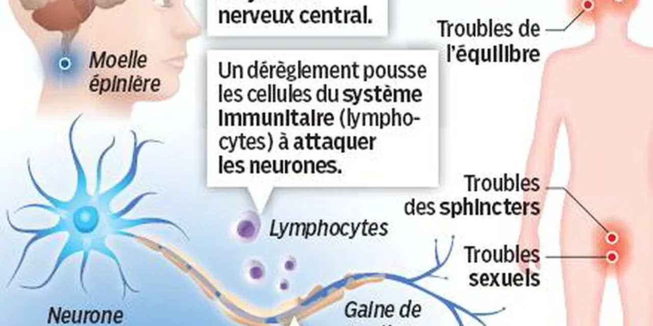 Comprendre la sclérose en plaques